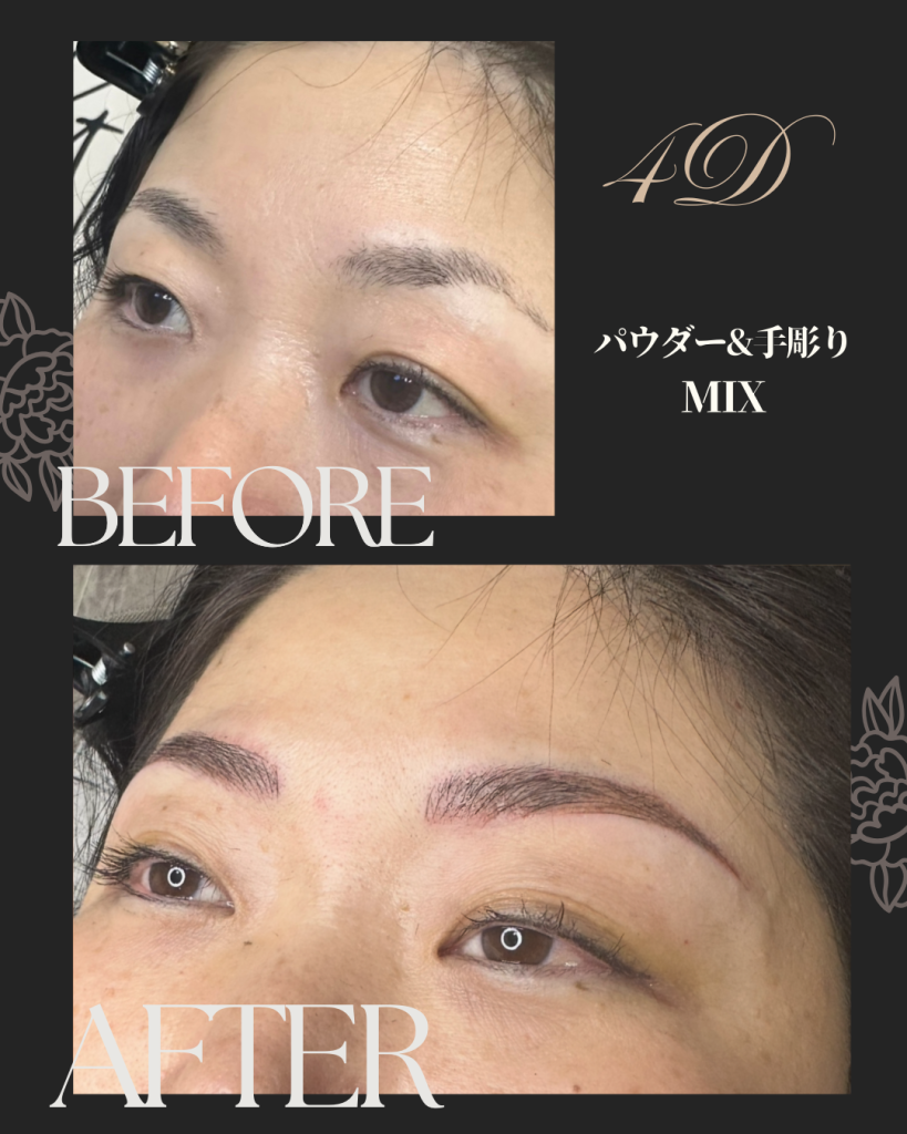 北九州・下関　医療アートメイク吉村ひろ美（吉村ひろみ）の症例写真　４Ⅾ眉